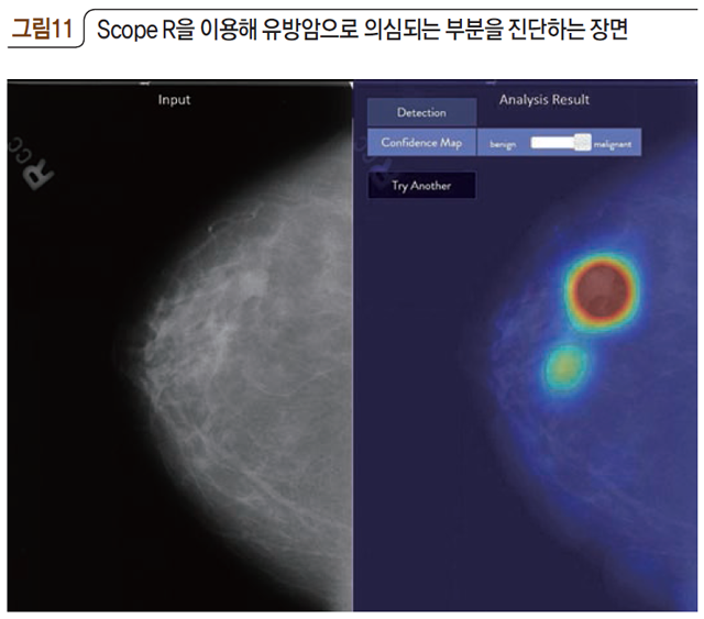 그림11 Scope R을 이용해 유방암으로 의심되는 부분을 진단하는 장면
