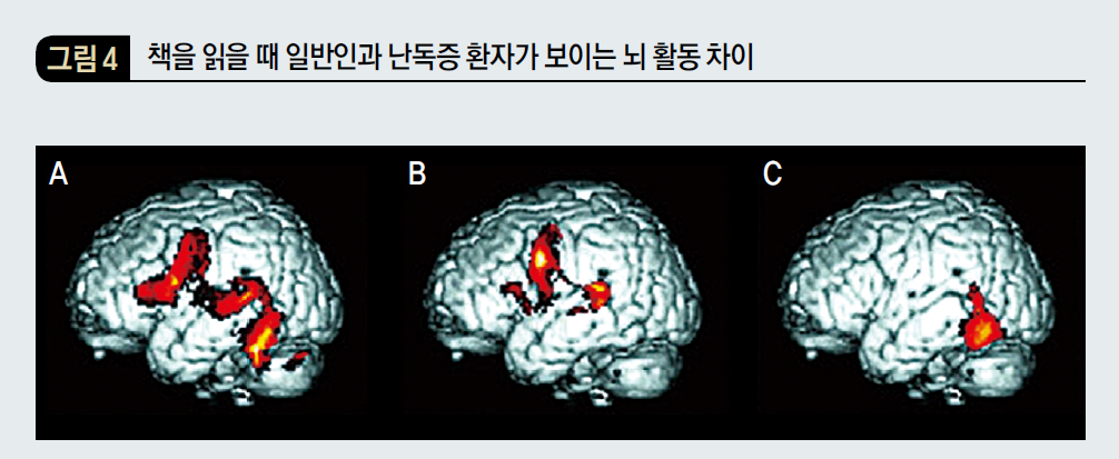 책을 읽을 때 일반인과 난독증 환자가 보이는 뇌 활동 차이