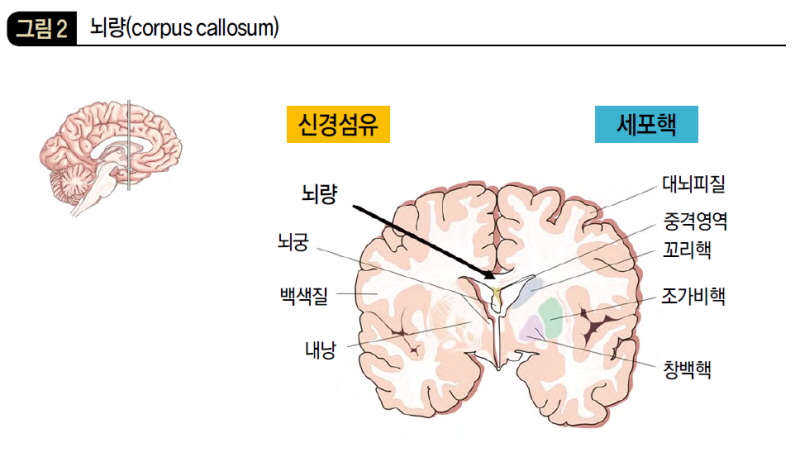 뇌량(corpus callosum)