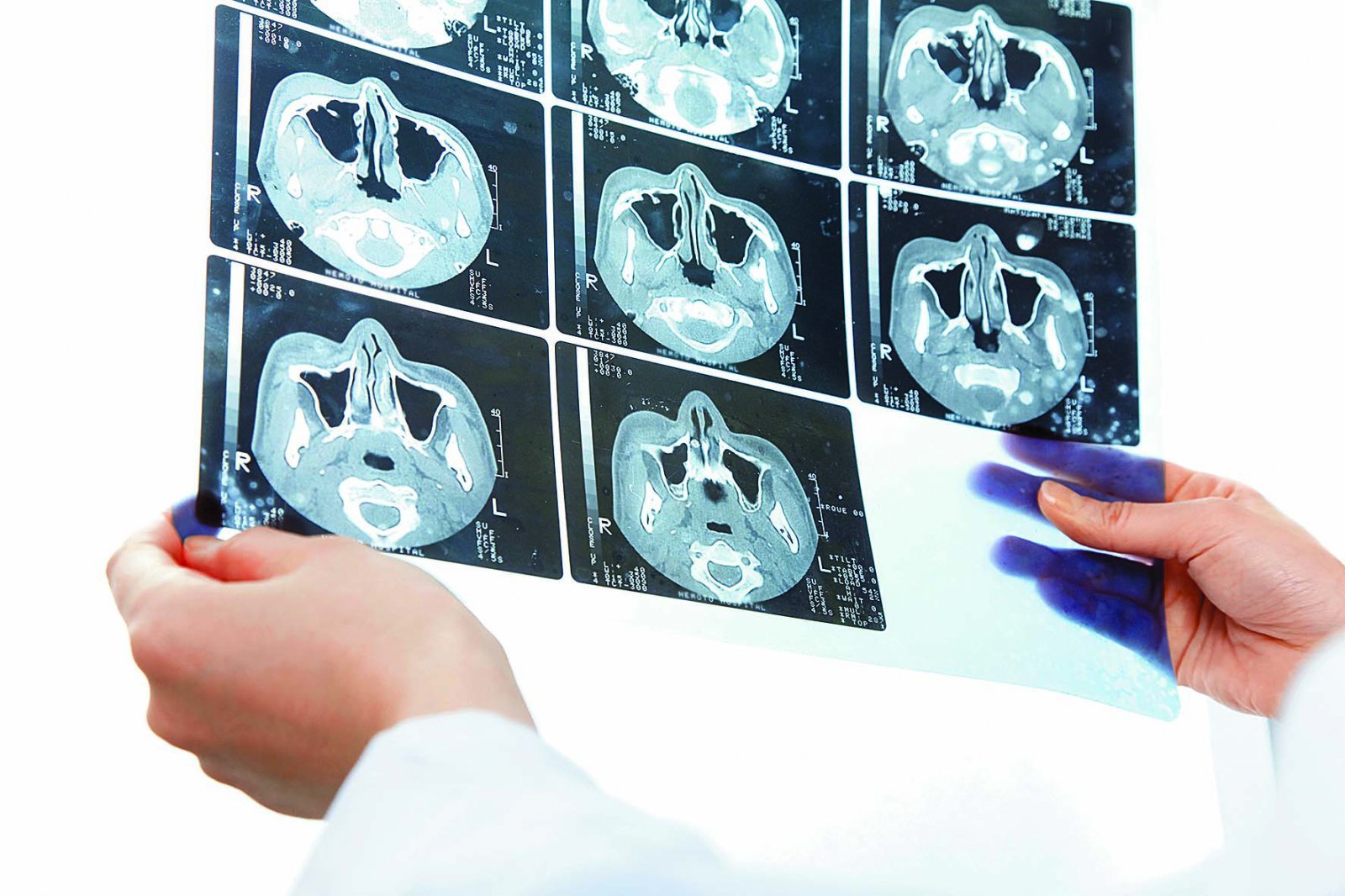 Early Lung Cancer Detection Boosts Survival, Preserves Function