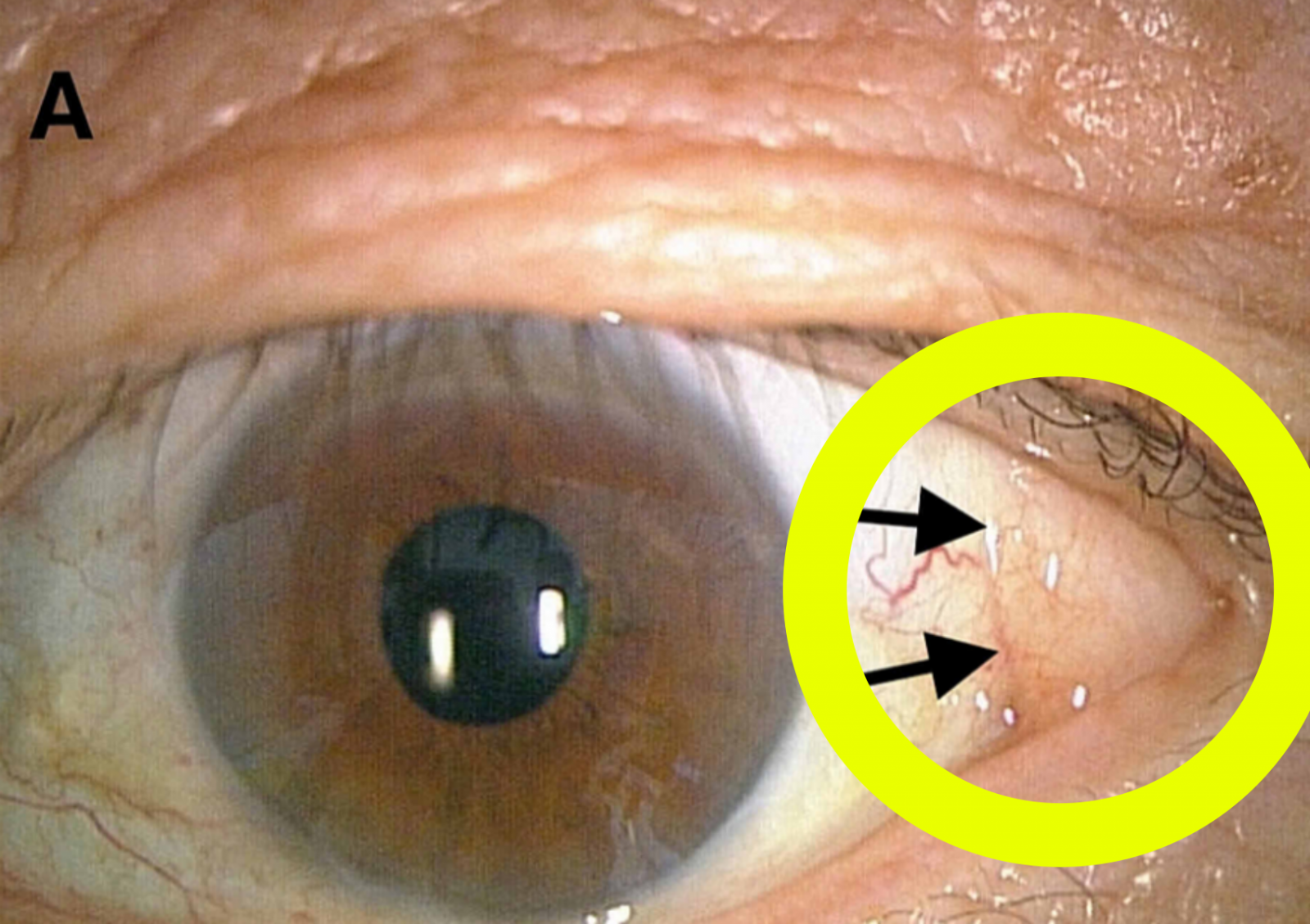 "Is Protruding Eye White Bump Safe?"