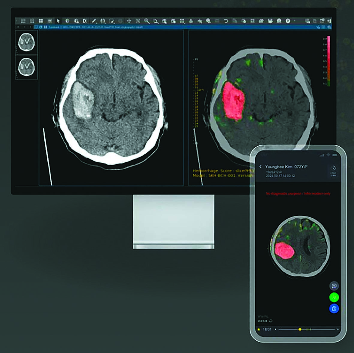 Purple AI Completes Stroke Diagnosis AI Portfolio