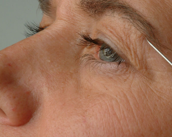 LG Study: Facial Aging Varies by Area