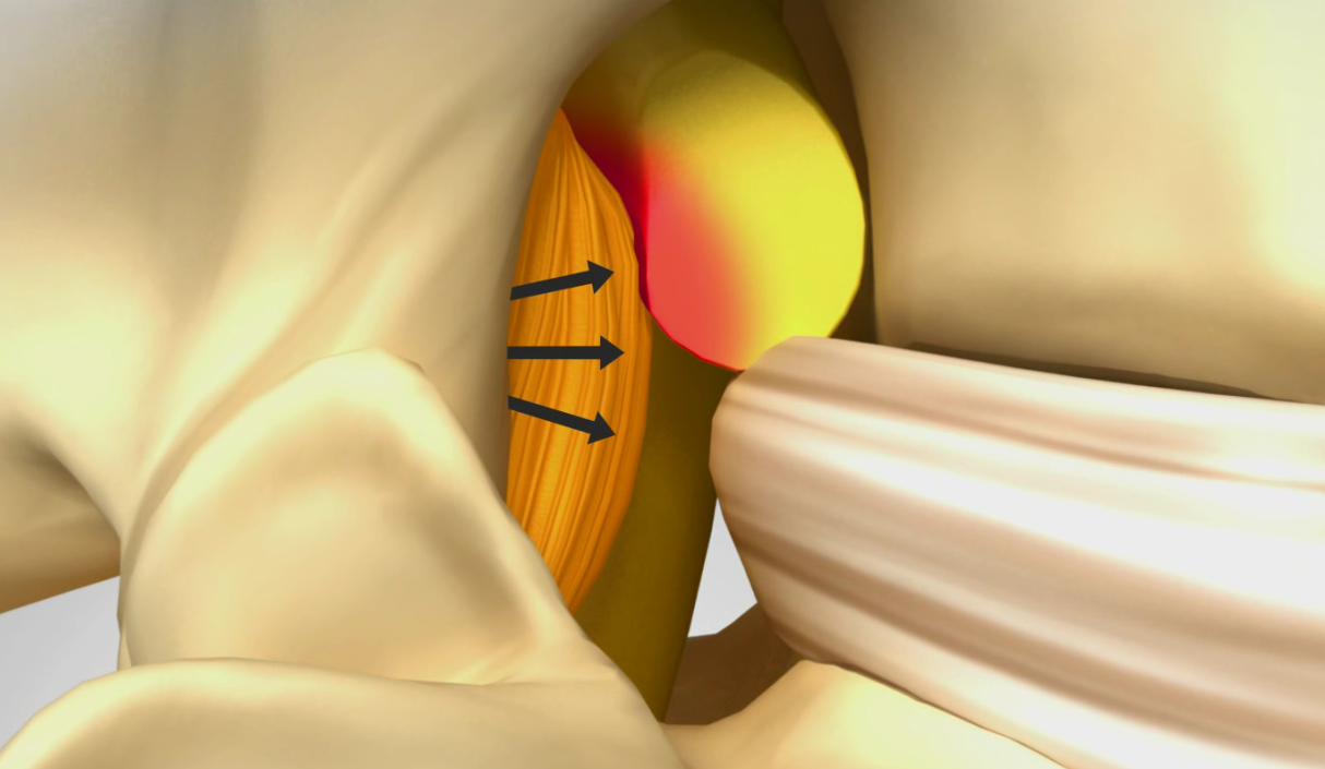 Back Surgery Shifts to Preservation as New Procedure Gains Notice