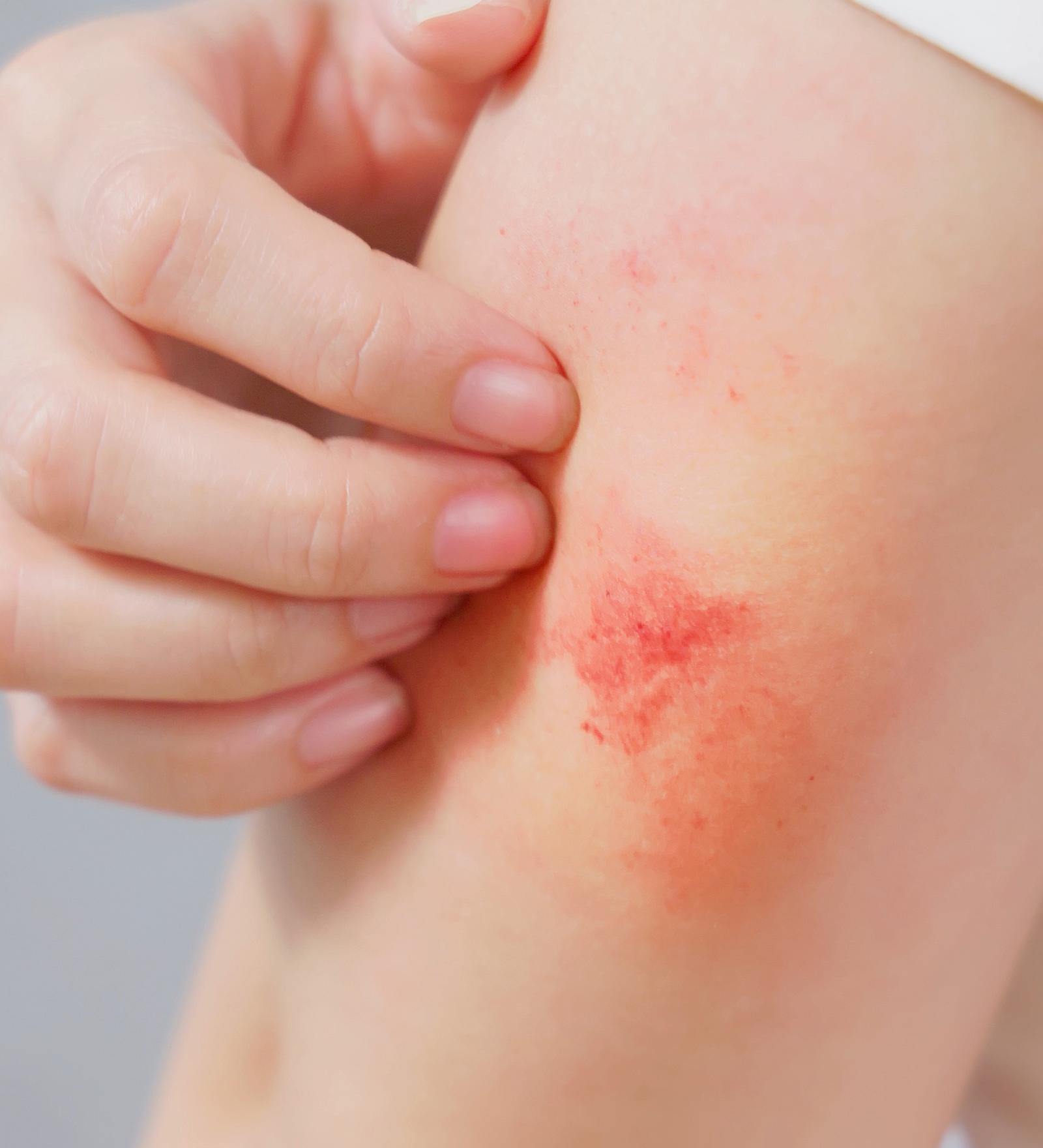Seasonal Shifts Worsen Atopic Dermatitis, Skin Barrier Key