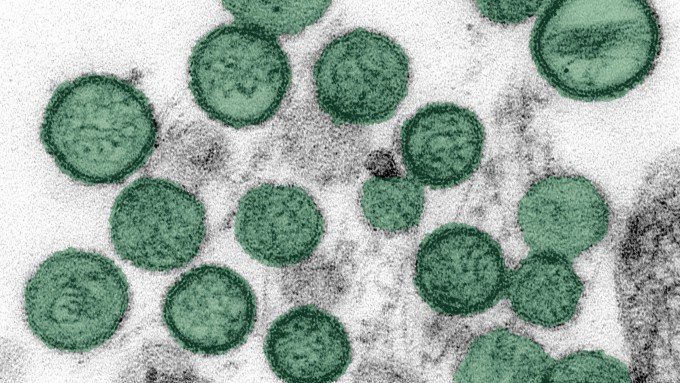 Hantavirus With 50% Fatality Rate Lacks Vaccine