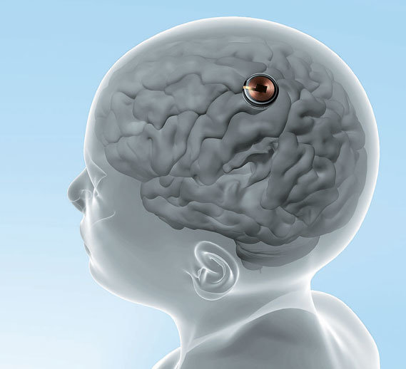 Musk’s ‘Brain Chip’ Nears BCI Commercialization